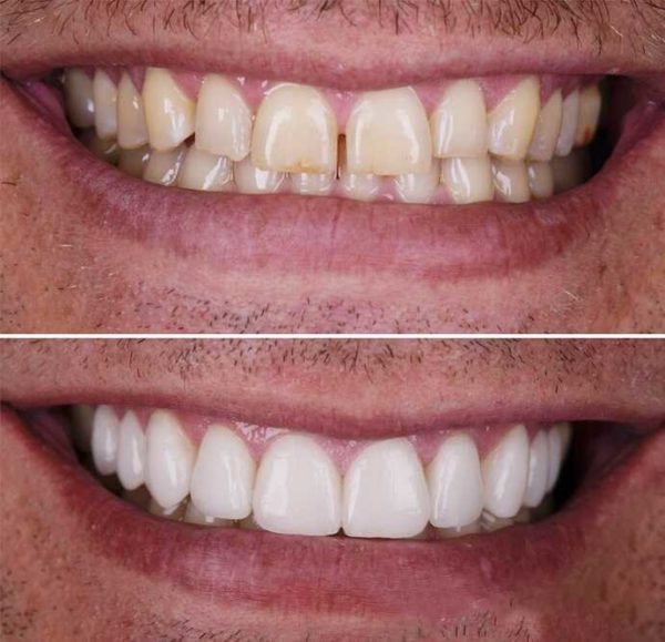 Veneers in Turkey Cosmedica Dental Clinic