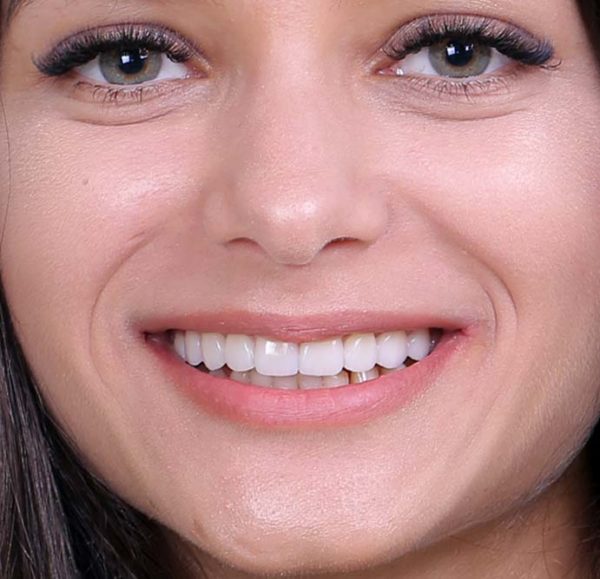 Refaire ses dents en Turquie