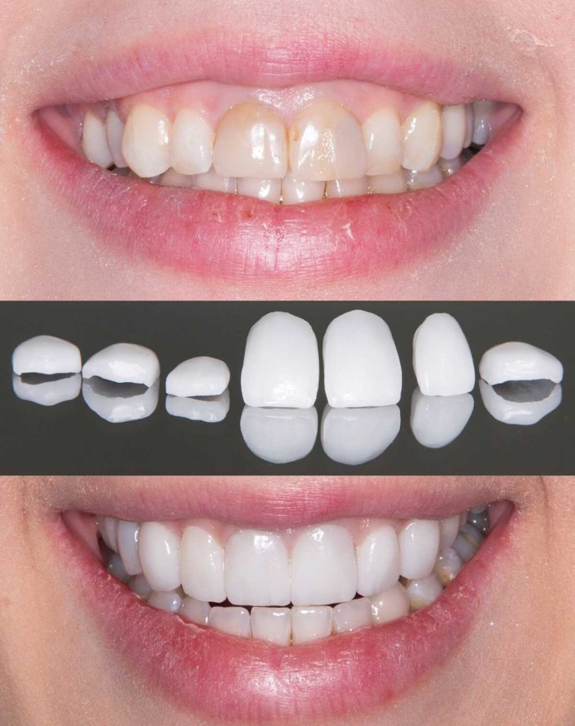 Veneers in Turkey Cosmedica Dental Clinic