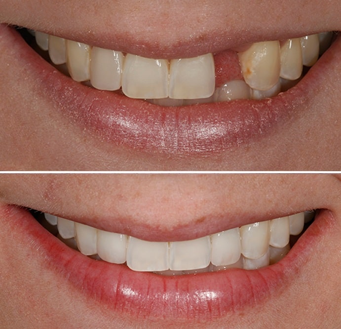 Implantate Zähne Türkei