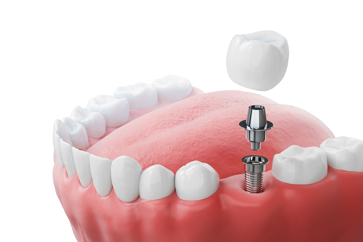 What Are The Stages Of A Tooth Implant Cosmedicadental