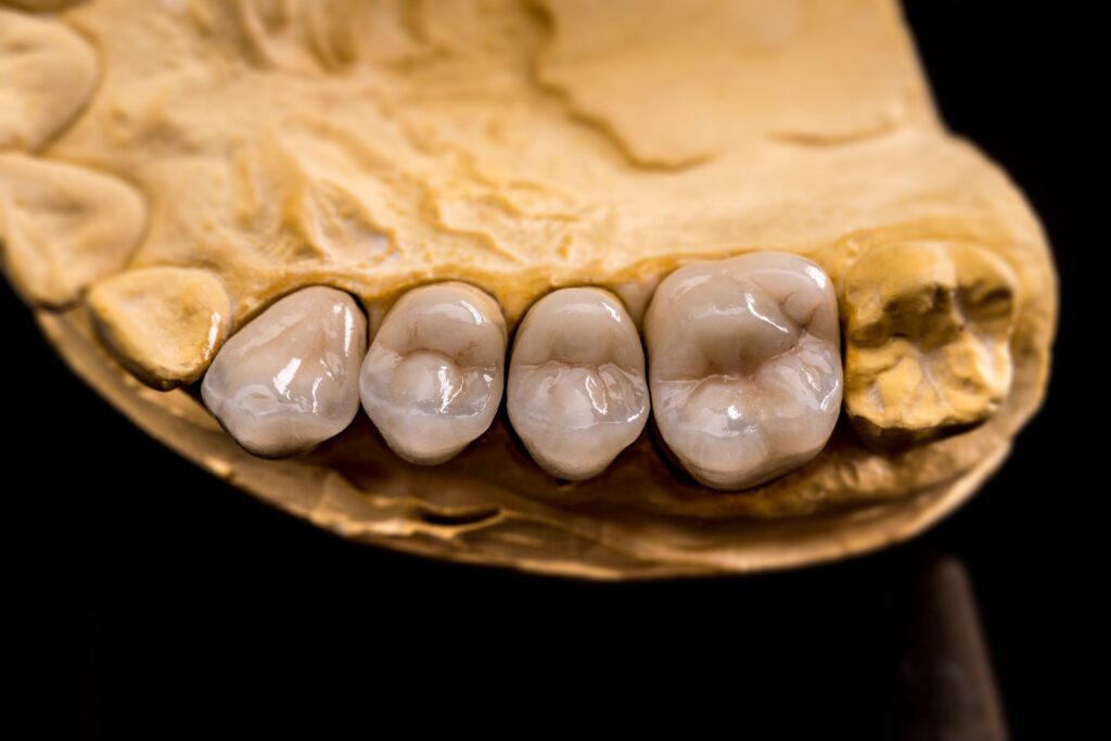 Model of a Dental prosthesis; Dental crown in Turkey