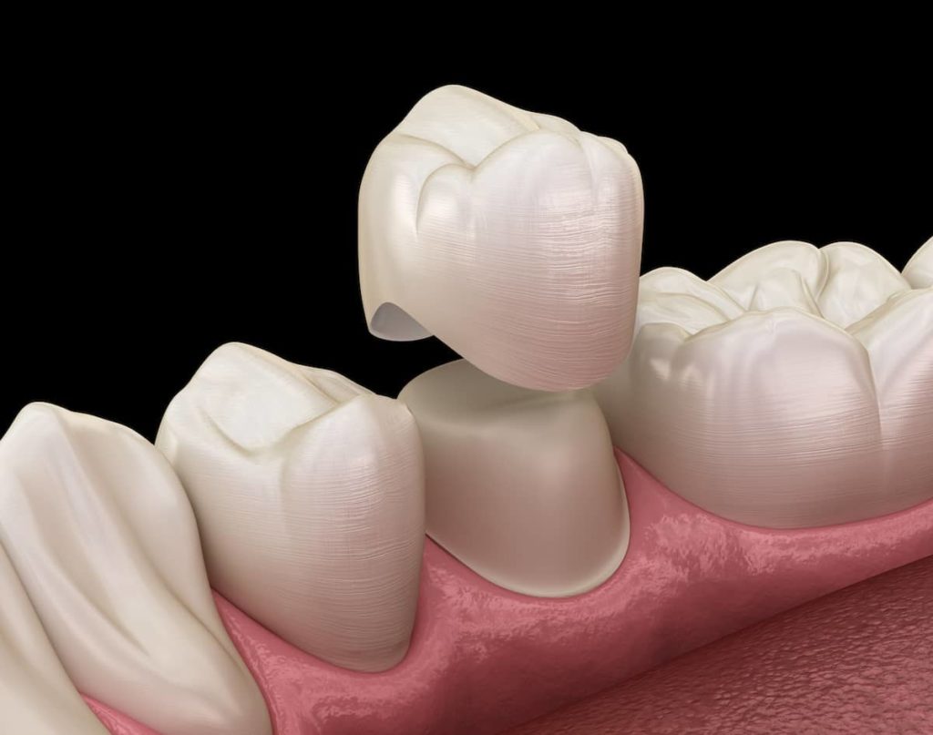 Illustration of a dental crown being placed on the prepared tooth during the dental crown process