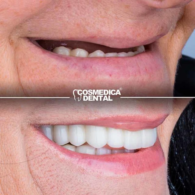 Turkey teeth before and after - Cosmedica Dental Clinic