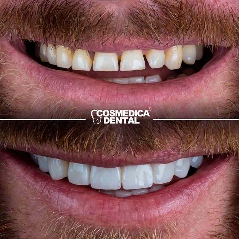 Before and after picture of a patient who had hollywood smile treatment