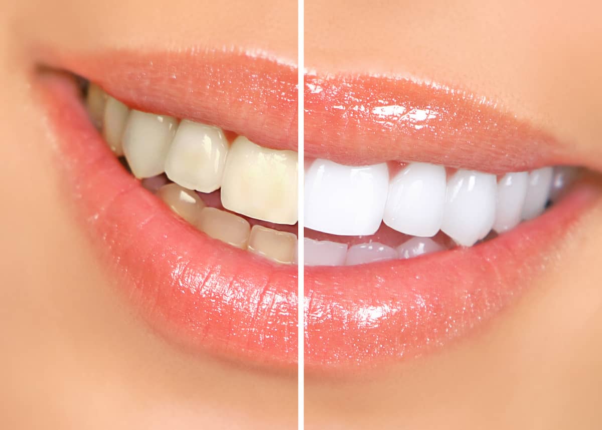 Vergleich von vorher-nachher von den Zähnen einer Frau nach dem Bleaching