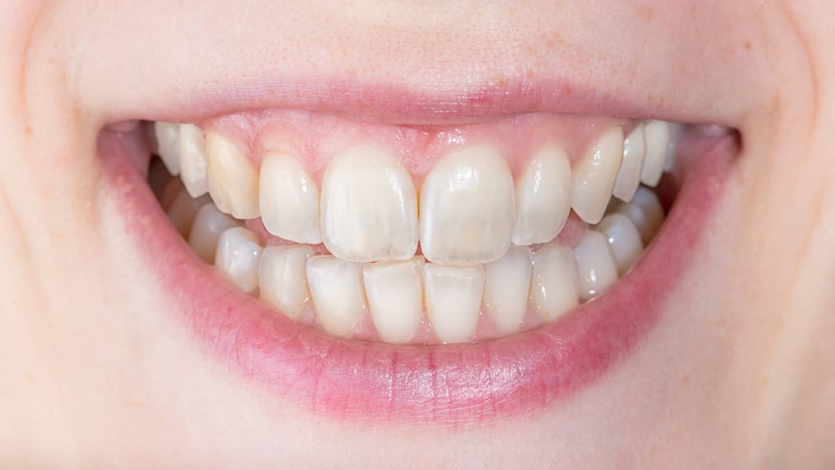 Frau mit transparenten Zähnen lächelt und zeigt ihre Zähne