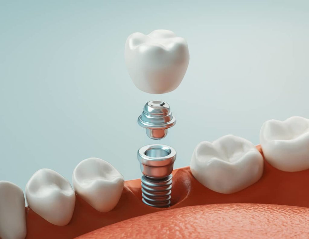Pose implant dentaire