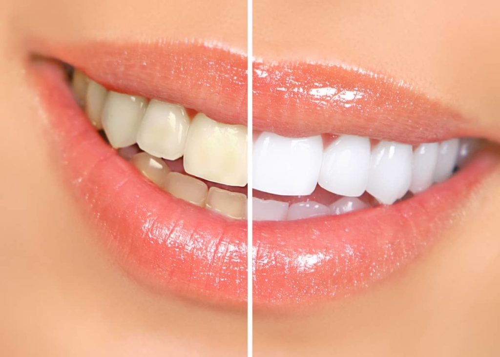 Effect of teeth whitening gels on the teeth of a woman