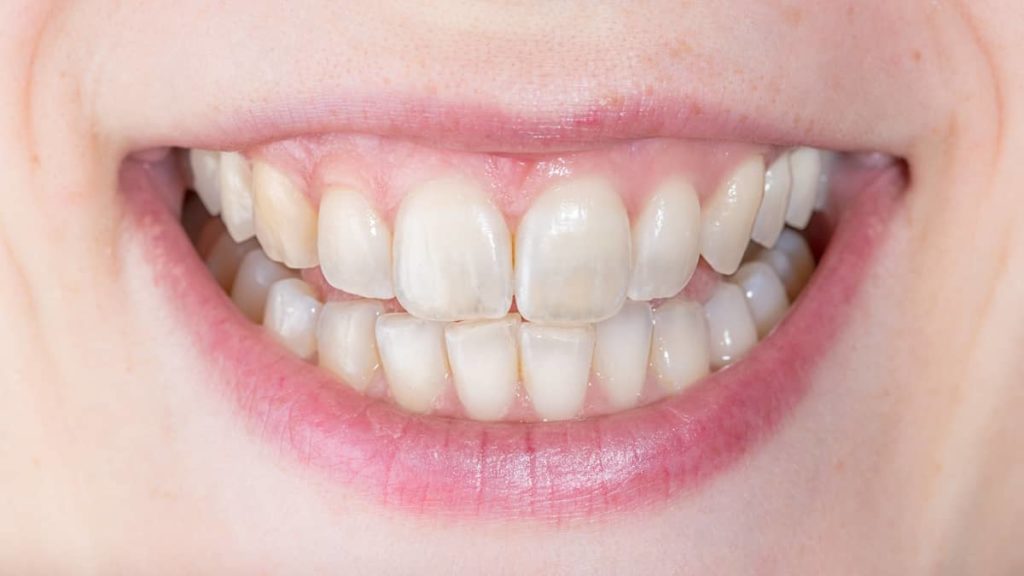 Woman with transparent teeth - close up of the teeth