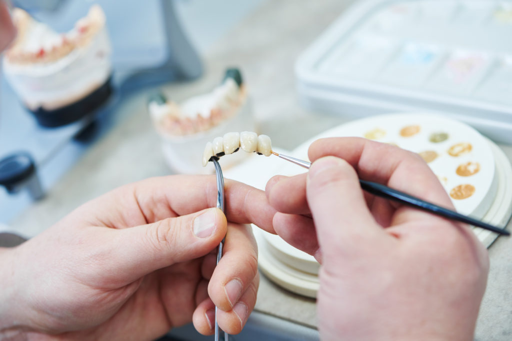 Une prothèse fixe est préparée pour être mise en place.