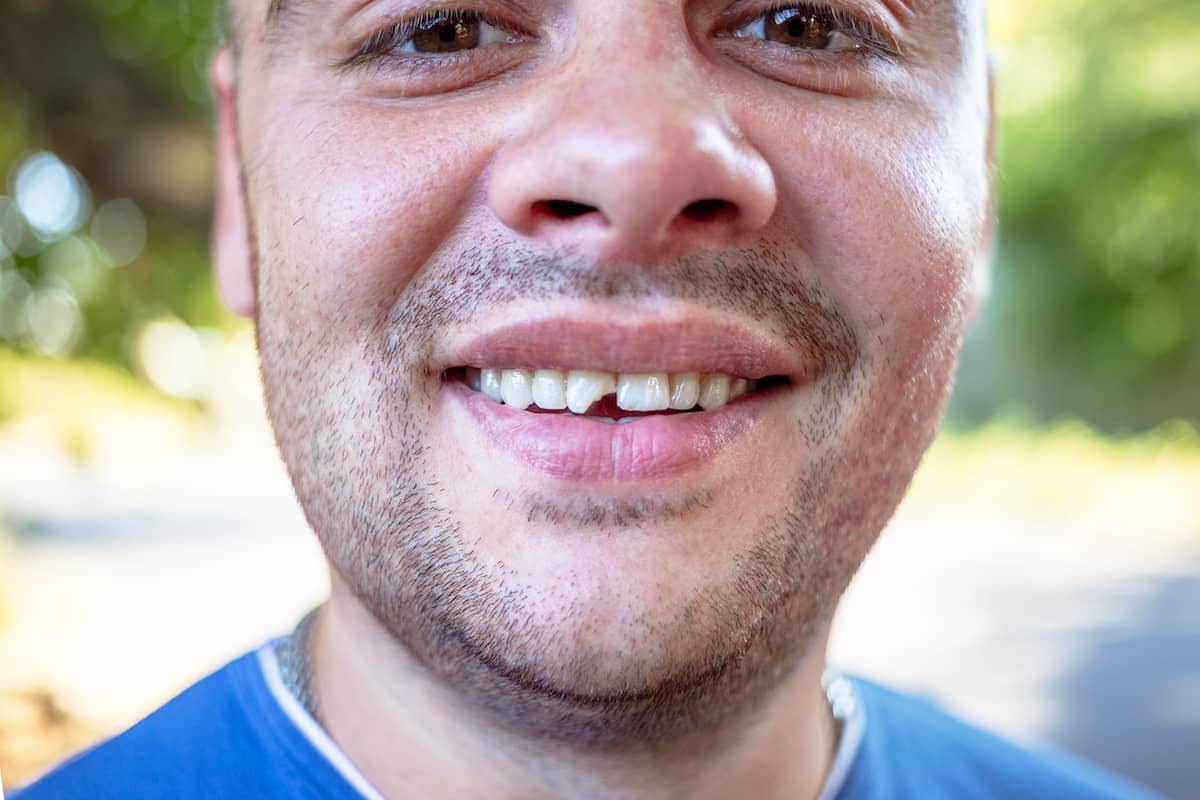 Man with chipped tooth - What are the options to fix chipped tooth?