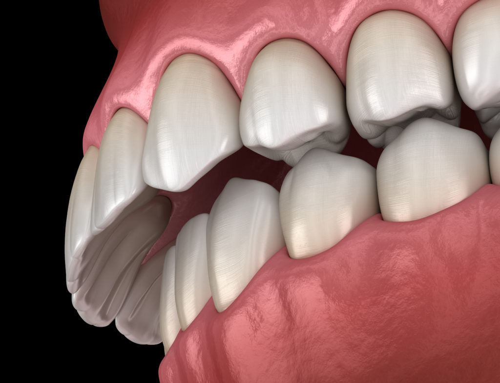 Supraclucion dentaire (Malocclusion des dents ). Illustration 3D de dent médicalement précise