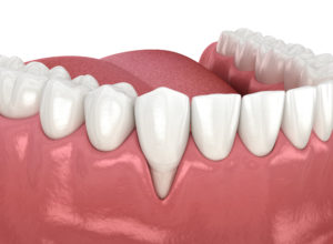 Künstlich erstelltes Bild zur Darstellung von einem Zahnfleischrückgang