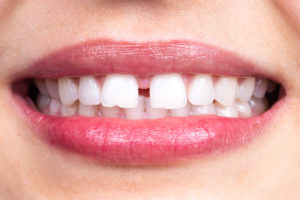 Nahaufnahme der Zähne einer jungen Frau mit einer Zahnlücke
