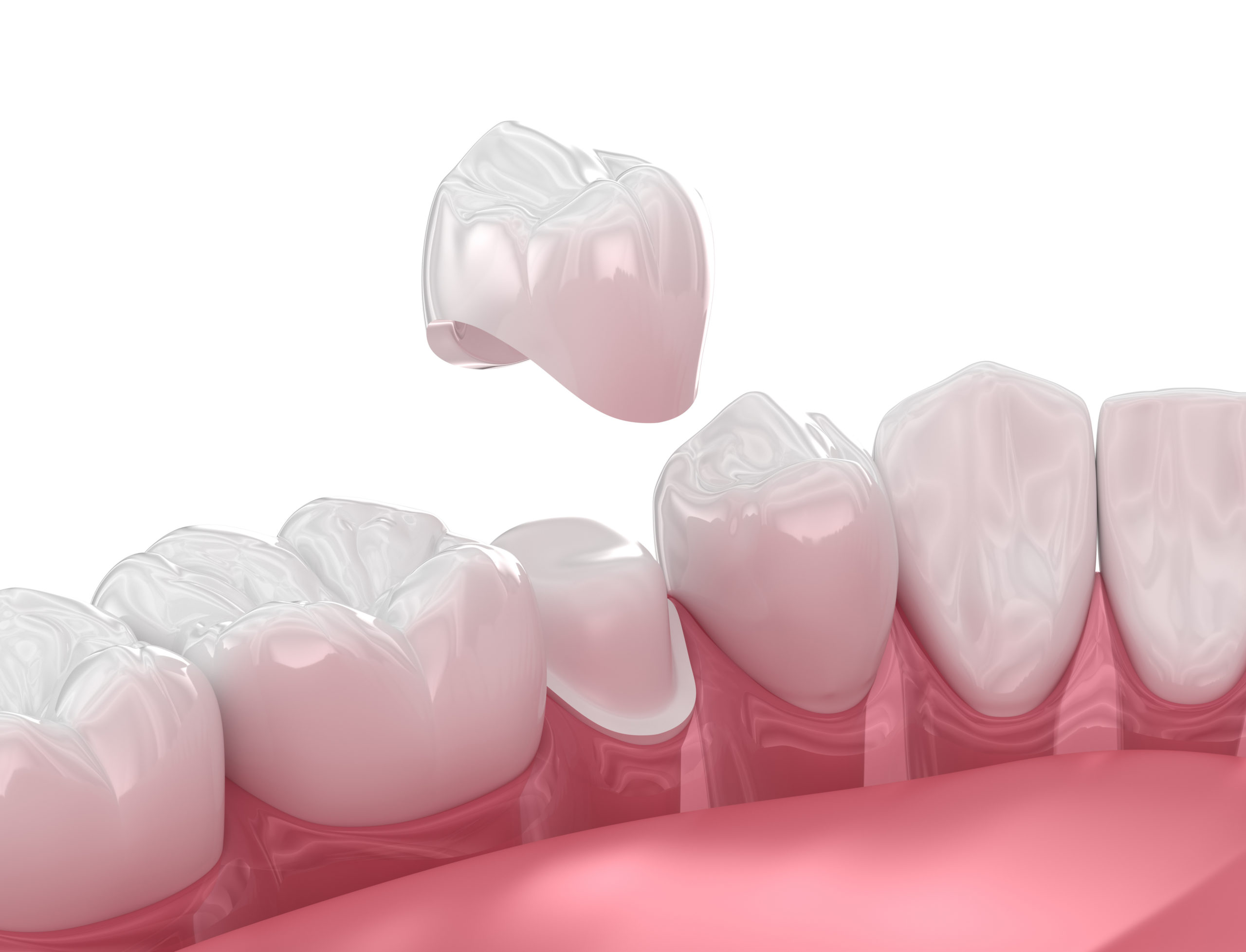 Dental porcelain crown placement over tooth. 3D illustration