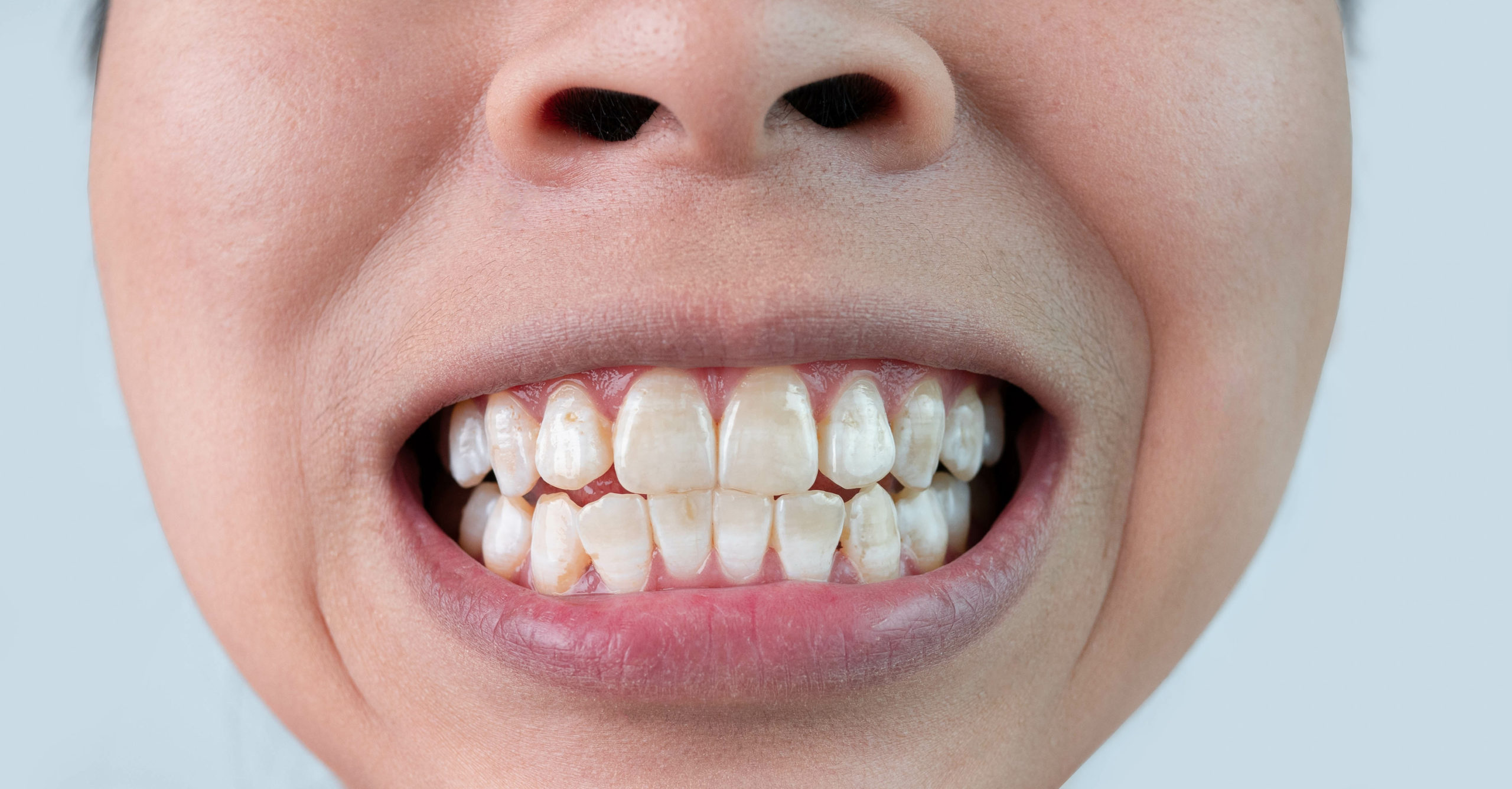 Gros plan d'une femme avec taches blanches sur les dents.