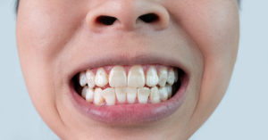 Close-up of a smiling woman's teeth revealing white spots on teeth surface.