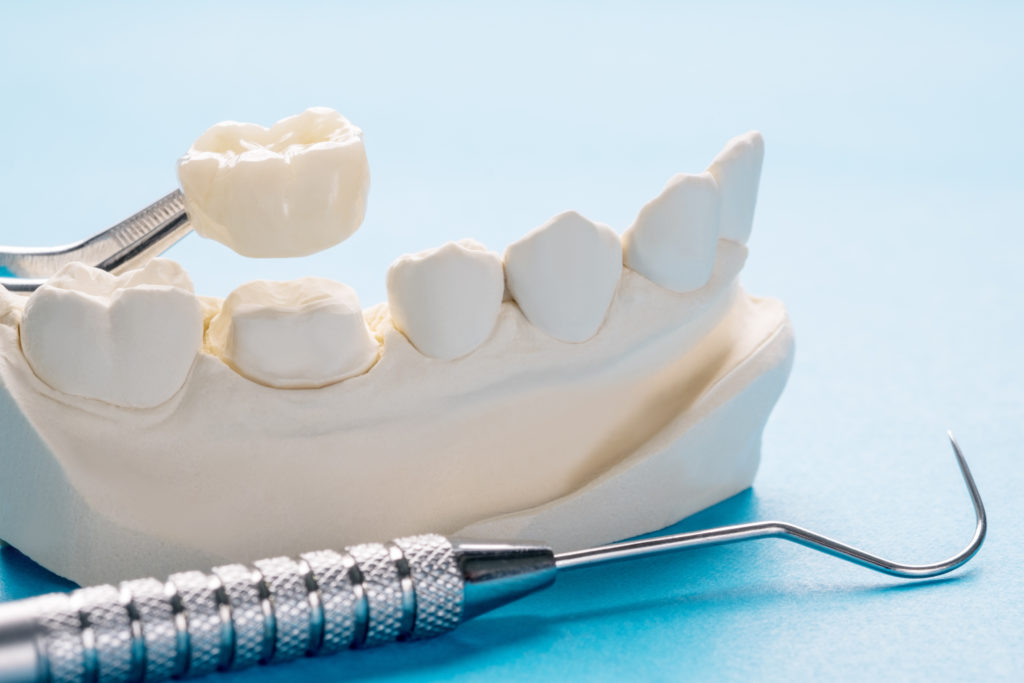 Close-up of zirconium crowns