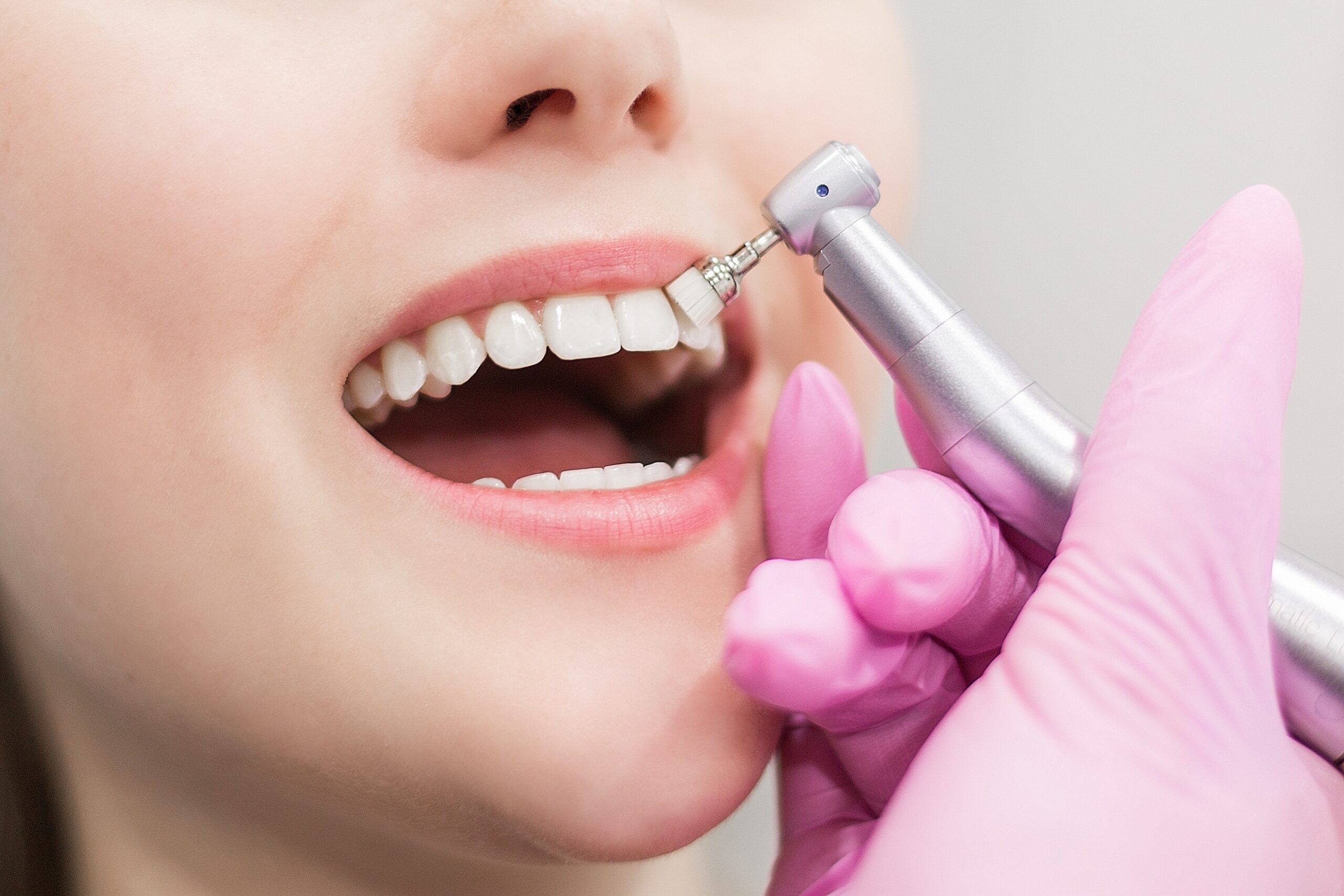 Young women is getting a dental scaling and polishing treatment