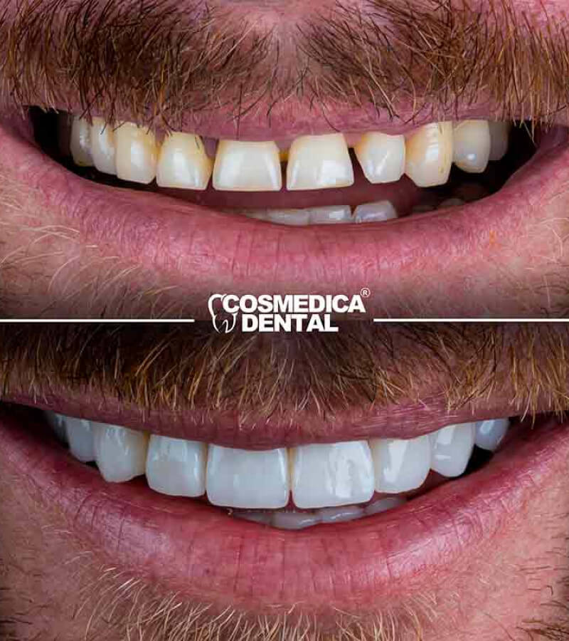 turkey-teeth-before-after-hollywood-smile