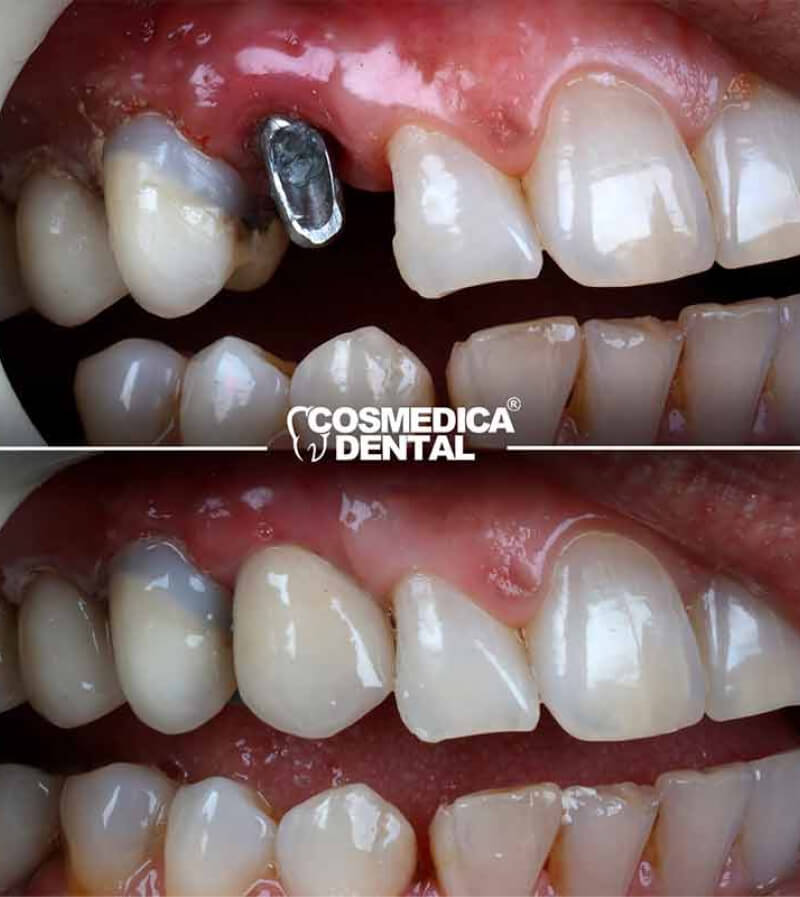 turkey-teeth-before-after-tooth-implant