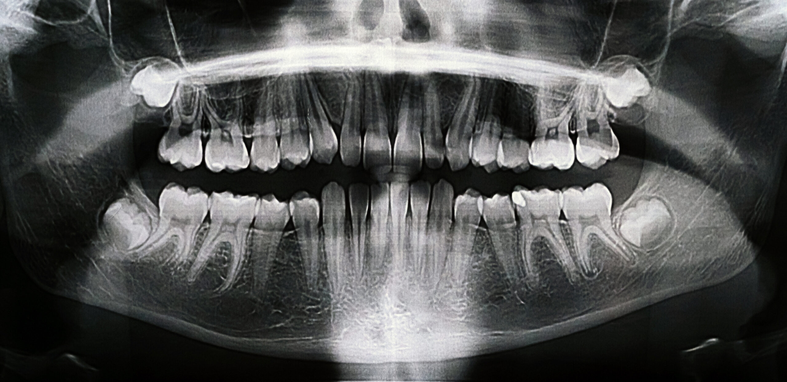 X-Ray des dents de sagesse