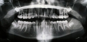 Panoramic X-ray of the wisdom teeth of a 12 year old girl