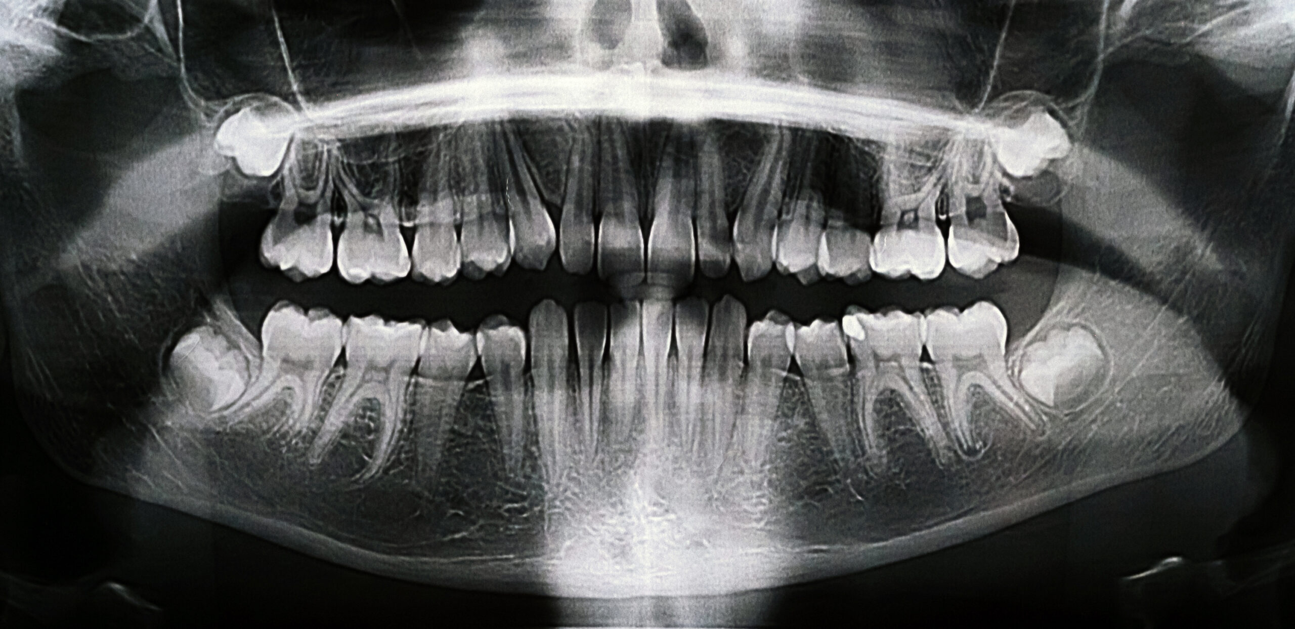 Panoramic X-ray of the wisdom teeth of a 12 year old girl