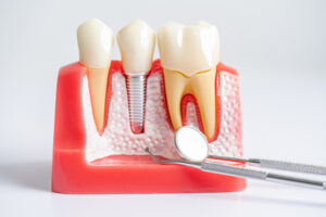 Künstlicher Kiefer mit einem Zahnimplantat; Können Zahnimplantate Krebs verursachen
