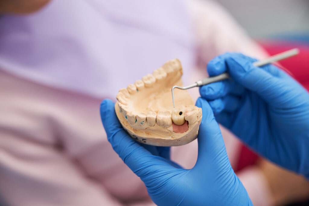 Dentist pointing out dental cavities on an artificial jaw