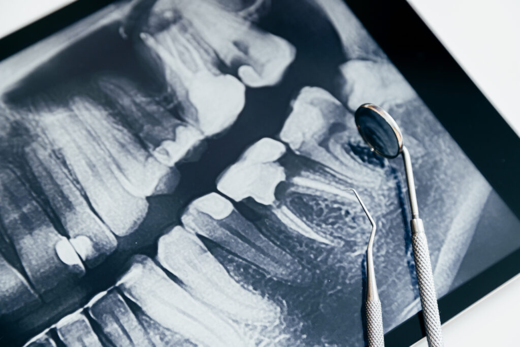 Bone graft for the jaw