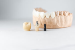 Model of artificial jaw and dental implant; How much do dental implants in Turkey cost