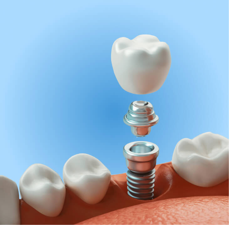 What are dental implants?