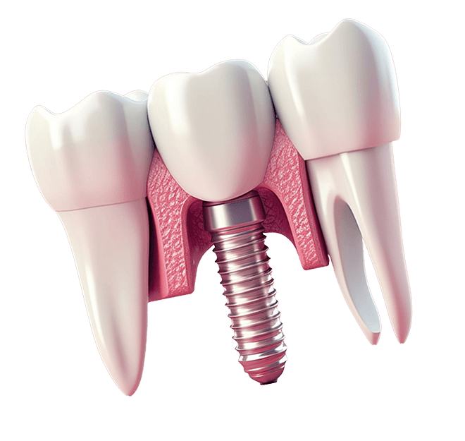 dental implants in Turkey