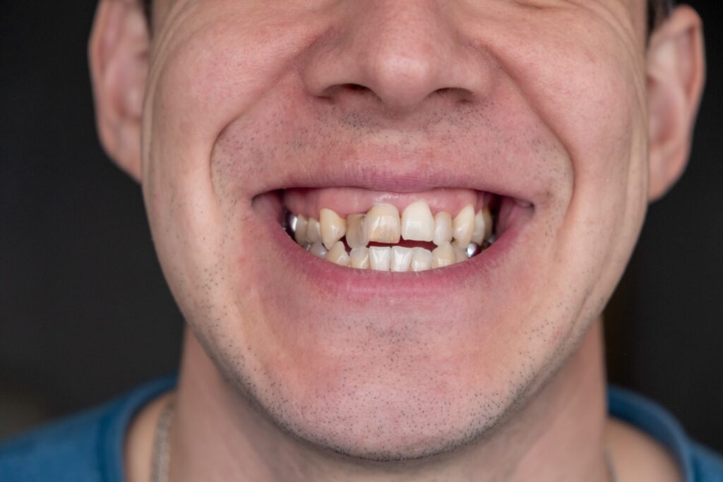 Homme avec malocclusion dentaire : un problème esthétique ?
