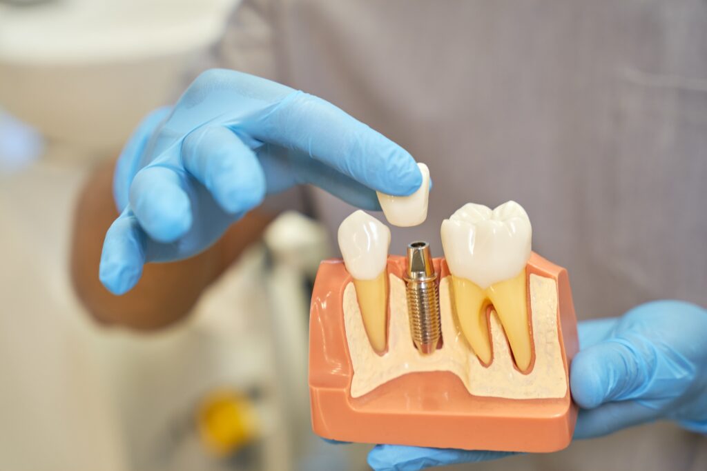 Plastic prop of teeth implant being shown by dentist; alternatives to dental implants